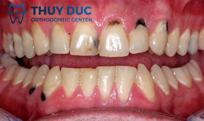 5. Niềng răng an toàn mà không cần bác sĩ chỉnh nha 1