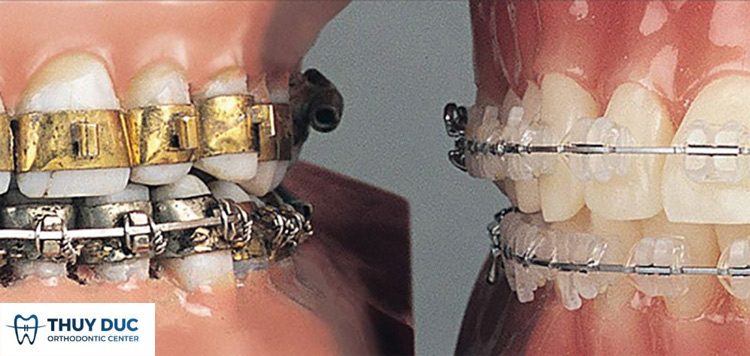 Sự phát triển của niềng răng trong thế kỷ 20 1 Sự phát triển của niềng răng trong thế kỷ 20 1