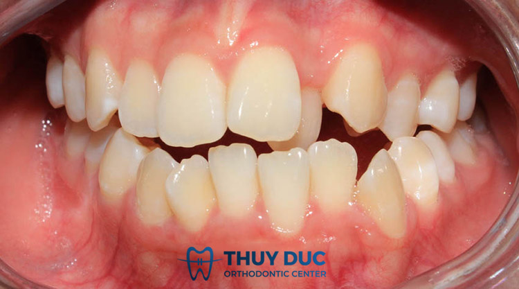 Vệ sinh răng miệng khó khăn 1 Vệ sinh răng miệng khó khăn 1