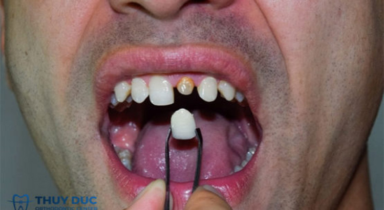 Chăm sóc răng sau khi bọc răng cửa thưa cần những điều gì?
