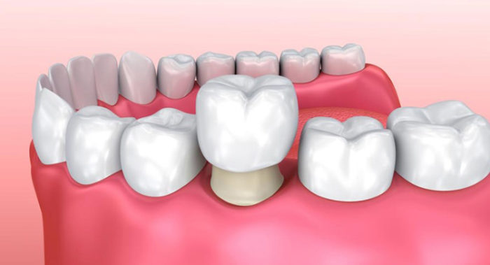 Bọc răng sứ 1 Bọc răng sứ 1
