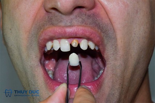 Răng cửa bị thưa có nên bọc sứ không? 1 Răng cửa bị thưa có nên bọc sứ không? 1
