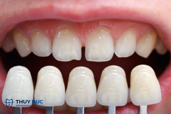 Bọc răng sứ có điều chỉnh được răng cửa thưa? 1 Bọc răng sứ có điều chỉnh được răng cửa thưa? 1