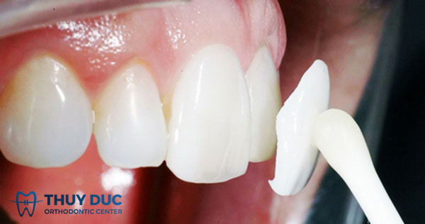 2. Dán sứ veneer 1