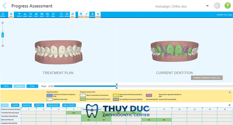 Máy quét dấu răng iTero 5D PLUS là công nghệ gì? 1 Máy quét dấu răng iTero 5D PLUS là công nghệ gì? 1