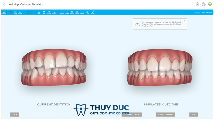 Lấy dấu răng bằng máy iTero 5D Plus mới nhất tại nha khoa Thúy Đức 3 Lấy dấu răng bằng máy iTero 5D Plus mới nhất tại nha khoa Thúy Đức 3
