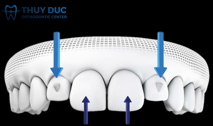 SmartForce là gì? Nó liên quan gì tới Invisalign 1