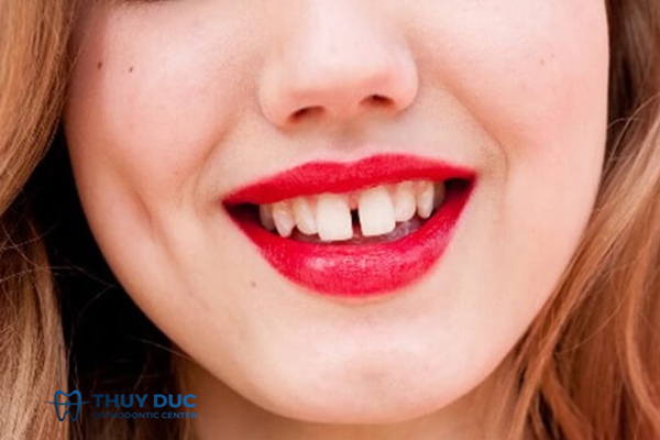 Xem nhân tướng về cuộc đời của người có răng cửa thưa 1