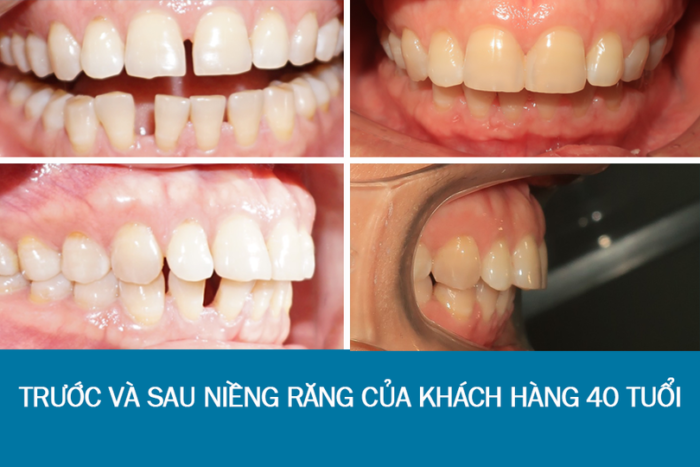 Răng thưa có niềng được không? 1 Răng thưa có niềng được không? 1