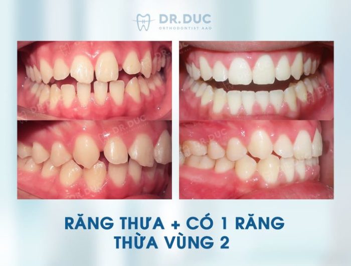 Niềng răng thưa có đắt không? Chi phí hết bao nhiêu? 1