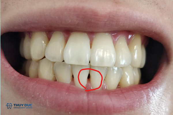 Điều trị răng cửa thưa bằng phương pháp niềng răng 1 Điều trị răng cửa thưa bằng phương pháp niềng răng 1