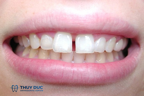Răng cửa thưa có thể được tránh bằng các biện pháp phòng ngừa hàng ngày không?