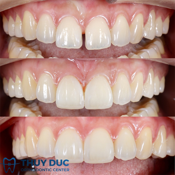 Trám răng che đi khe hở giữa hai răng cửa 1 Trám răng che đi khe hở giữa hai răng cửa 1