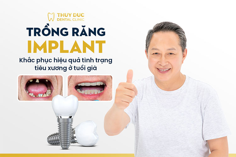 Trồng răng implant cải thiện khoảng trống giữa các răng 1 Trồng răng implant cải thiện khoảng trống giữa các răng 1