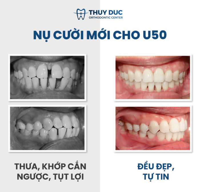 Niềng răng thưa có hiệu quả không? Quy trình thế nào? 1 Niềng răng thưa có hiệu quả không? Quy trình thế nào? 1
