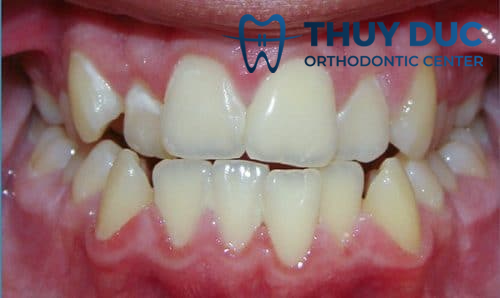 Hình ảnh khớp cắn đối đầu 1