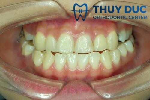 Hình ảnh khớp cắn đối đầu 2