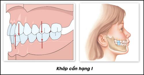 Tác hại của sai khớp cắn loại 1 1 Tác hại của sai khớp cắn loại 1 1
