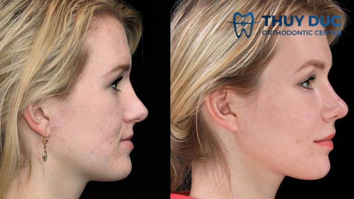 Người bị khớp cắn ngược có nên tập Mewing? 2 Người bị khớp cắn ngược có nên tập Mewing? 2