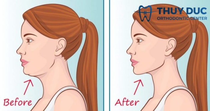 Người bị khớp cắn ngược có nên tập Mewing? 1 Người bị khớp cắn ngược có nên tập Mewing? 1