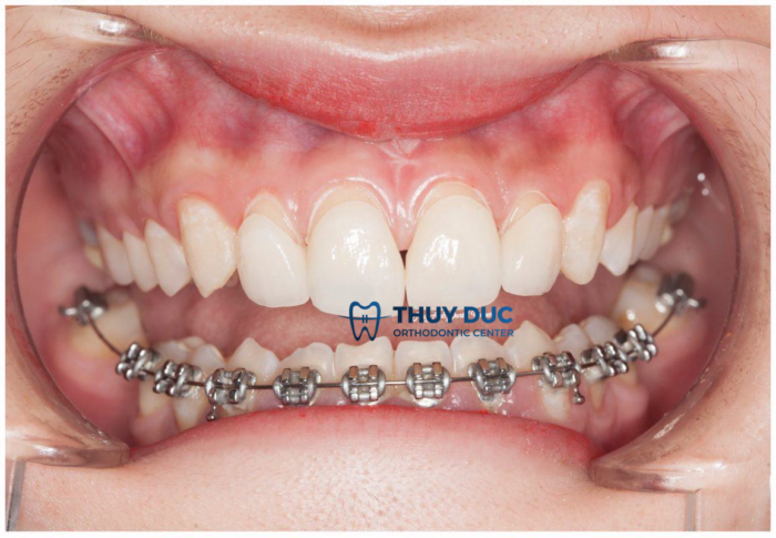 Chỉ niềng răng 1 hàm dưới có được không? 1 Chỉ niềng răng 1 hàm dưới có được không? 1