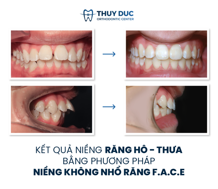 Răng Thưa Nhẹ: Nguyên Nhân và Giải Pháp Hiệu Quả