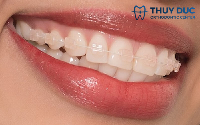 Niềng răng thưa hàm dưới bằng mắc cài sứ 1 Niềng răng thưa hàm dưới bằng mắc cài sứ 1