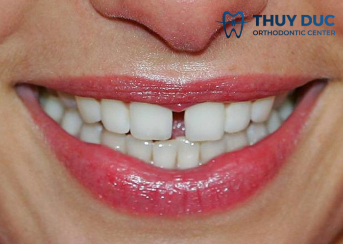 Niềng răng thưa mất bao lâu? 1 Niềng răng thưa mất bao lâu? 1