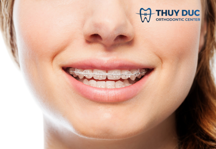 Niềng răng thưa mất bao lâu thì có hàm răng đẹp? 1 Niềng răng thưa mất bao lâu thì có hàm răng đẹp? 1