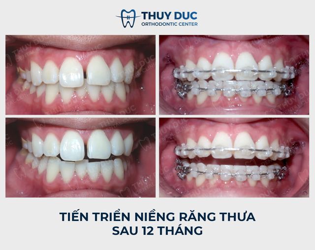 Niềng răng thưa và hô có khó không? 1 Niềng răng thưa và hô có khó không? 1