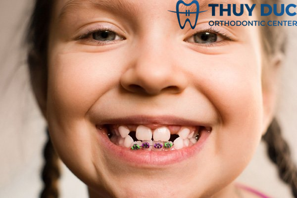 Độ tuổi niềng răng chỉnh nha 1 Độ tuổi niềng răng chỉnh nha 1