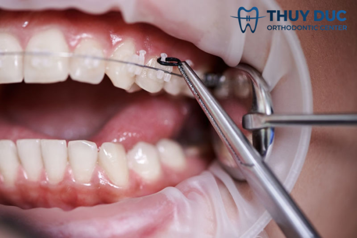 Nguyên nhân nào khiến răng bị thưa sau khi niềng? 1 Nguyên nhân nào khiến răng bị thưa sau khi niềng? 1