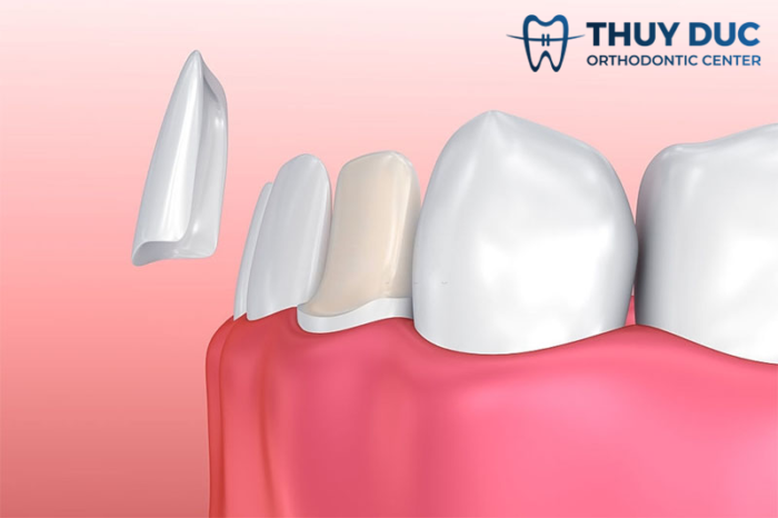 Dán mặt sứ cho răng thưa 1 Dán mặt sứ cho răng thưa 1