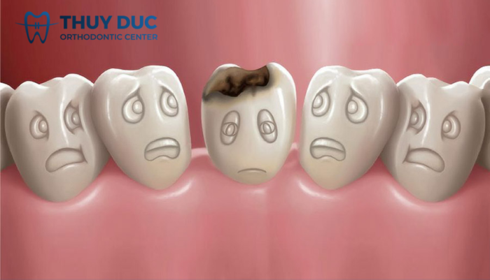 Trường hợp nào nên trám răng cửa thưa? 3 Trường hợp nào nên trám răng cửa thưa? 3