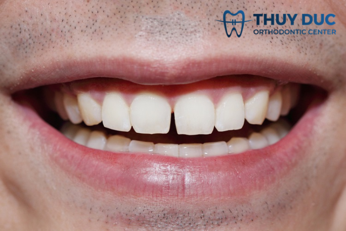 Răng bị thưa sau khi niềng nên xử lý thế nào? 1