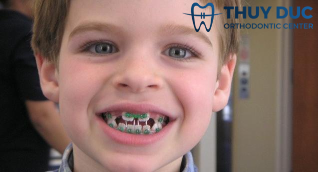 Với phương pháp niềng răng thưa 1 Với phương pháp niềng răng thưa 1
