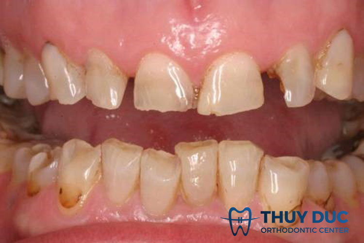 Tác hại của khớp cắn đối đầu 1