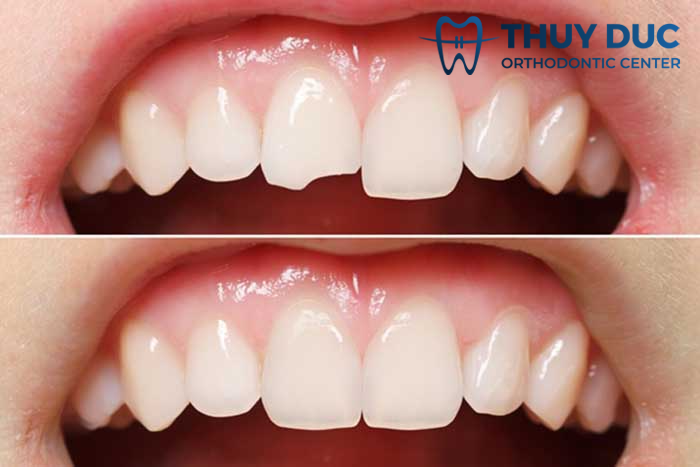 Trám răng thẩm mỹ hay dùng vật liệu nào? 1 Trám răng thẩm mỹ hay dùng vật liệu nào? 1