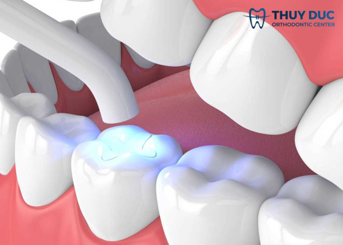 Trám răng cửa thưa giữ được bao lâu? 1 Trám răng cửa thưa giữ được bao lâu? 1