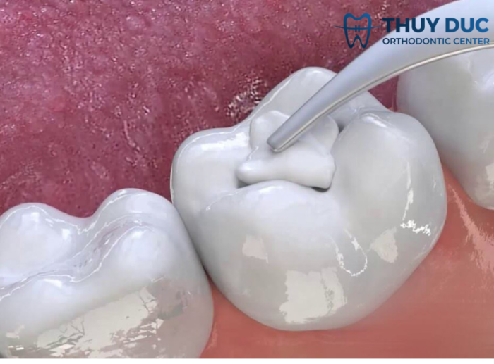 Trám răng Composite 1 Trám răng Composite 1