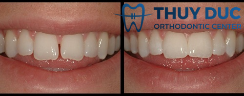 Mất răng thưa có ảnh hưởng gì đến chức năng nhai?
