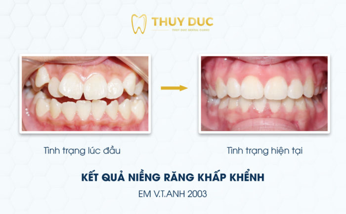 Sai khớp cắn loại 1 là gì? Khắc phục như thế nào? 1 Sai khớp cắn loại 1 là gì? Khắc phục như thế nào? 1