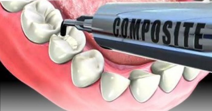 Vật liệu trám răng cửa thưa 1 Vật liệu trám răng cửa thưa 1