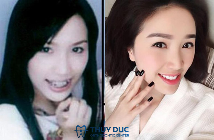Niềng răng có giúp cho mũi cao hơn không? 5