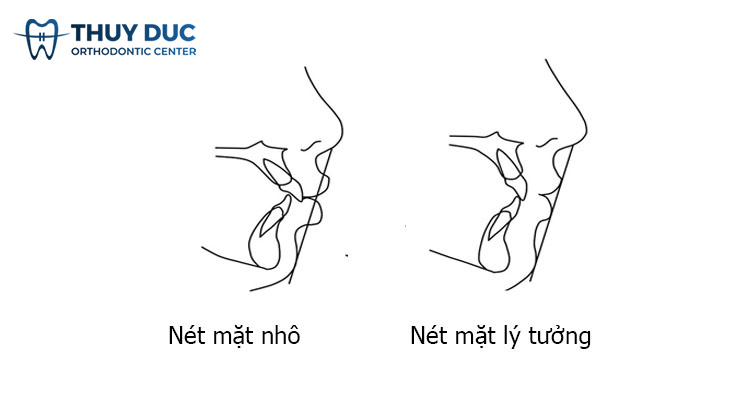 Niềng răng có giúp cho mũi cao hơn không? 1