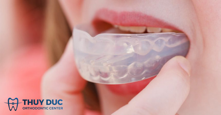 Niềng răng Trainer A1 A2 A3 hiệu quả ra sao? 1