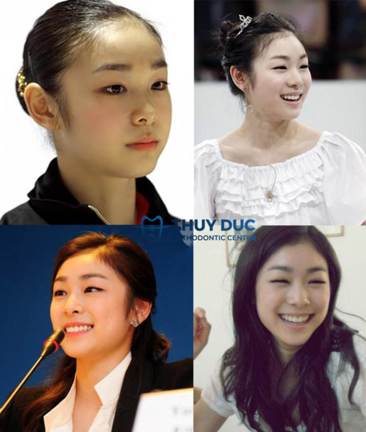 Niềng răng có giúp cho mũi cao hơn không? 6