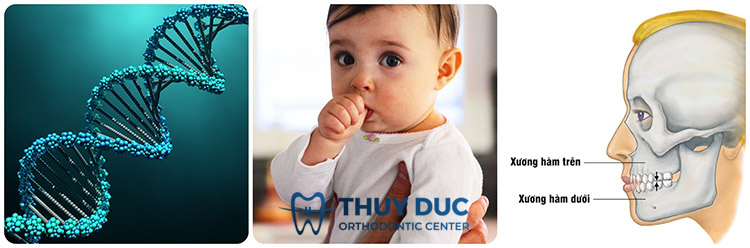 Nguyên nhân dẫn tới răng cửa chữ V? 1 Nguyên nhân dẫn tới răng cửa chữ V? 1