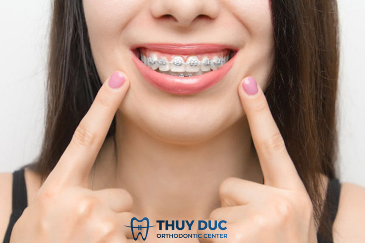 Ưu điểm của mắc cài kim loại 3M 1 Ưu điểm của mắc cài kim loại 3M 1