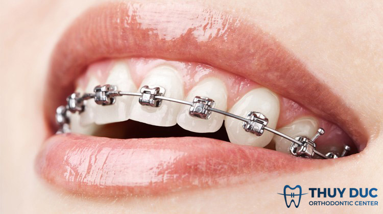 Niềng răng mắc cài kim loại 1